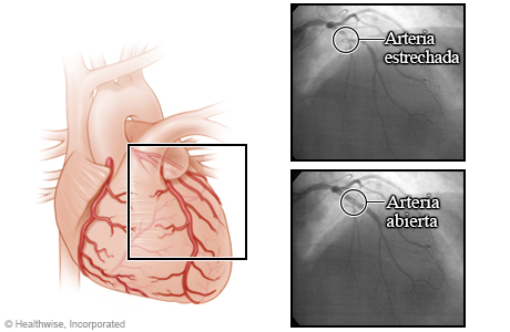 Arterias antes y después de una angioplastia
