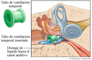 Tubo de ventilación colocado en el oído y líquido que drena en el conducto auditivo
