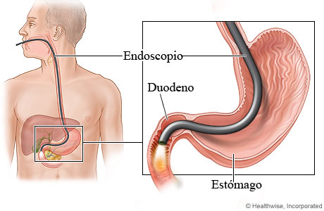Imagen de una endoscopia gastrointestinal superior