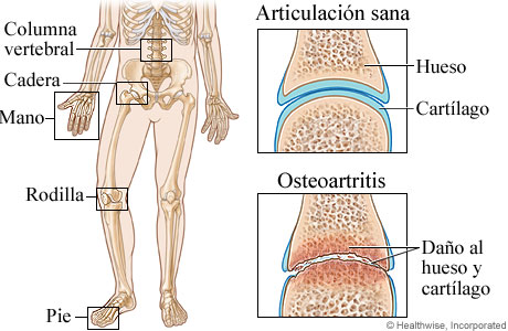 Articulaciones comúnmente afectadas por la osteoartritis