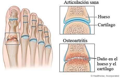 Articulación sana y artrosis del pie