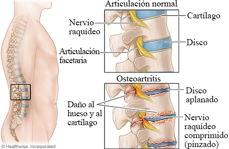 Columna vertebral normal y osteoartritis de la columna vertebral