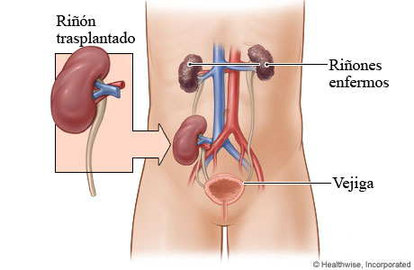 Un riñón trasplantado