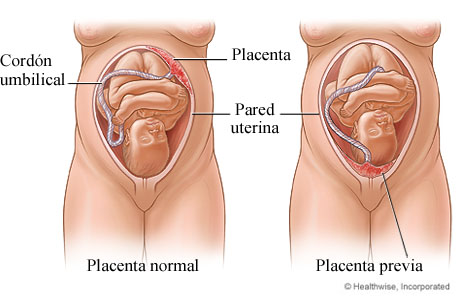 Imagen de placenta normal y placenta previa