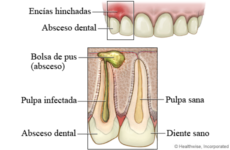 Encías hinchadas y absceso dental, con detalle de un absceso dental y un diente sano