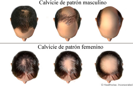 Progresión de caída de cabello hereditaria en hombres y mujeres