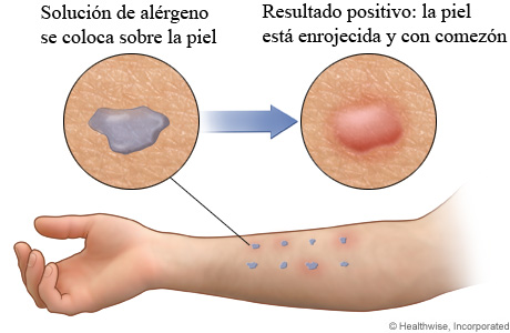 Solución de alérgeno en el brazo y resultado positivo