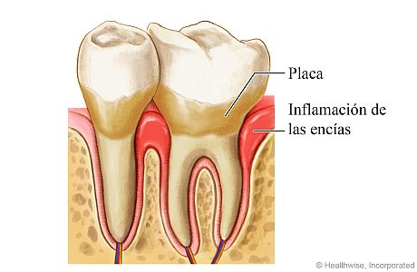 Enfermedad de las encías alrededor de un diente, que muestra placa e inflamación de las encías