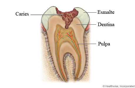 Caries dental a través del esmalte y que llega a la dentina