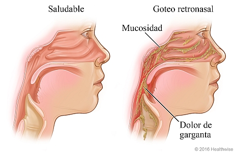 Vista interna de la cabeza, que muestra los senos paranasales con goteo retronasal cayendo en la garganta