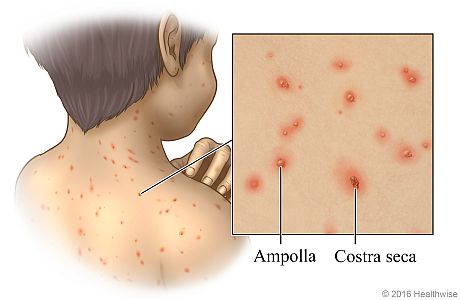 Salpullido típico de la varicela en la espalda de un niño, con detalle que muestra las ampollas y las costras secas