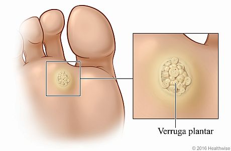 Verruga plantar en la planta del pie debajo de los dedos con un primer plano de la verruga elevada e irregular.