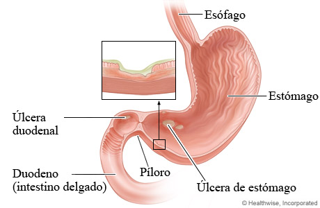Úlceras pépticas en el estómago y en el duodeno