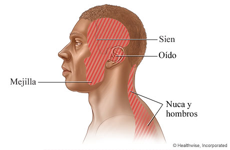 Zonas donde puede haber dolor por trastorno temporomandibular: La mejilla, la sien, el oído, y el cuello y los hombros