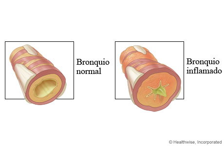 Bronquios normales e inflamados