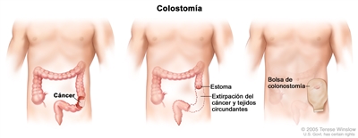 La ilustración a tres paneles muestra una cirugía del cáncer de colon con colostomía; el primer panel muestra el área del colon con cáncer, el panel medio muestra la extirpación del cáncer y tejidos circundantes y la creación de un estoma, el último panel muestra la bolsa de colostomía adherida al estoma.