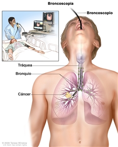 Broncoscopia; el dibujo muestra un broncoscopio insertado a través de la boca, la tráquea y el bronquio hasta el pulmón; los ganglios linfáticos a lo largo de la tráquea y los bronquios, y el cáncer en un pulmón. El recuadro muestra al paciente acostado sobre una camilla mientras se le realiza la broncoscopia.