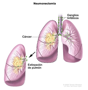Neumonectomía. En la imagen se observan la tráquea, los ganglios linfáticos y los pulmones (con cáncer en un pulmón). Se muestra el pulmón con cáncer que se extirpó.