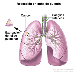 Resección en cuña de pulmón. En la imagen se observan la tráquea y los pulmones con cáncer en uno de los lóbulos del pulmón. Se muestra el tejido extirpado del pulmón con cáncer y una pequeña cantidad del tejido sano que lo rodea; también se muestra el lóbulo del pulmón del que se extrajo el tejido.