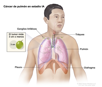 Cáncer de pulmón en estadio IA. En la imagen se observa un tumor que mide 3 cm o menos en el pulmón derecho. También se observan los ganglios linfáticos, la tráquea, la pleura y el diafragma.