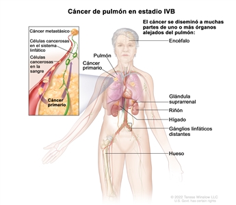 Cáncer de pulmón en estadio IVB. En la imagen se observan cáncer primario en el pulmón izquierdo y otras partes del cuerpo donde es posible que se disemine el cáncer de pulmón: el encéfalo, la glándula suprarrenal, el riñón, el hígado, los ganglios linfáticos distantes y el hueso. En un recuadro, se muestran células cancerosas que se diseminan desde el pulmón, a través de la sangre y el sistema linfático, hasta otra parte del cuerpo donde se formó el cáncer metastásico.