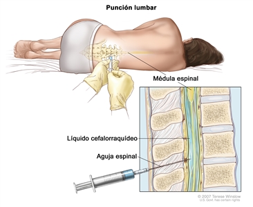 Punción lumbar; la imagen muestra a un paciente acostado sobre una camilla en posición encorvada y una aguja intrarraquídea o espinal, la cual es larga y fina, que se inserta en la parte inferior de la espalda. El recuadro muestra una vista de cerca de esta aguja insertada en el líquido cefalorraquídeo (LCR), en la parte inferior de la columna vertebral.