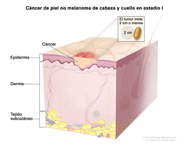 Cáncer de piel no melanoma de cabeza y cuello en estadio I. En la imagen se observa cáncer en la epidermis. En un recuadro se muestra que el tumor mide 2 cm o menos y que 2 cm es casi el tamaño de un maní. También se muestran la dermis y el tejido subcutáneo debajo de la dermis.