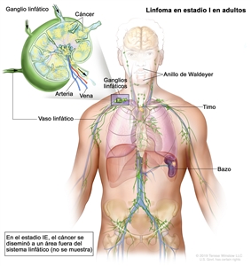 Linfoma en estadio I en adultos. En la imagen se observa cáncer en 1 grupo de ganglios linfáticos y en el bazo. También se observan el anillo de Waldeyer y el timo. En una ampliación, se muestran un ganglio linfático, un vaso linfático, una arteria y una vena. Se observan células cancerosas en el ganglio linfático.