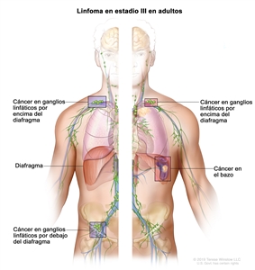 Linfoma en estadio III en adultos. En la imagen se observan el lado derecho y el lado izquierdo del cuerpo. En el lado derecho del cuerpo, se muestra cáncer en grupos de ganglios linfáticos encima y debajo del diafragma. En el lado izquierdo del cuerpo, se muestra cáncer en un grupo de ganglios linfáticos encima del diafragma y en el bazo.