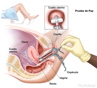 Prueba de Pap. En la imagen se observa una vista lateral anatómica del aparato reproductor femenino durante una prueba de Pap. Se observa un espéculo que abre la vagina. Se muestra un cepillo que se introduce en la vagina mientras está abierta y que toca el cuello uterino en la base del útero. También se observa el recto. En un recuadro, se observa el cepillo tocando el centro del cuello uterino. En otro recuadro de la parte superior izquierda de la imagen, se muestra a una mujer con una sábana, acostada en una camilla con las piernas separadas y los pies apoyados en unos soportes.