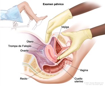 Examen pélvico. En la imagen se muestra una vista lateral anatómica del aparato reproductor femenino durante un examen pélvico. Se observan el útero, la trompa de Falopio izquierda, el ovario izquierdo, el cuello uterino, la vagina, la vejiga y el recto. El médico o enfermero introduce dos dedos enguantados en la vagina, mientras la otra mano presiona la parte inferior del abdomen. En la parte superior izquierda de la imagen, se muestra a una mujer cubierta por una sábana en una camilla que tiene las piernas separadas y los pies en los estribos.