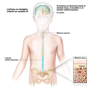 Linfoma no Hodgkin infantil en estadio IV. En la imagen se observa el encéfalo, la médula espinal, y el líquido cefalorraquídeo en el interior y alrededor del encéfalo y la médula espinal. En el recuadro se observa cáncer en la médula ósea.