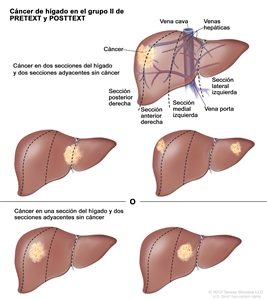 Cáncer de hígado en el grupo II de PRETEXT y POSTTEXT. En la imagen se observan 5 hígados. Las líneas punteadas dividen cada hígado en 4 secciones verticales de casi el mismo tamaño. En el primer hígado, el cáncer se encuentra en las 2 secciones de la izquierda. En el segundo hígado, el cáncer se encuentra en las 2 secciones de la derecha. En el tercer hígado, el cáncer se encuentra en la sección extrema izquierda y en la sección extrema derecha. En el cuarto hígado, el cáncer se encuentra en la segunda sección desde la izquierda. En el quinto hígado, el cáncer se encuentra en la segunda sección desde la derecha.