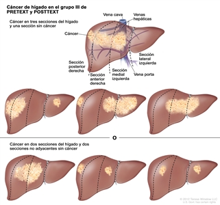 Cáncer de hígado en el grupo III de PRETEXT y POSTTEXT. En la imagen se observan 7 hígados. Las líneas punteadas dividen cada hígado en 4 secciones verticales de casi el mismo tamaño. En el primer hígado, el cáncer se encuentra en 3 secciones de la izquierda. En el segundo hígado, el cáncer se encuentra en las 2 secciones de la izquierda y en la sección extrema derecha. En el tercer hígado, el cáncer se encuentra en la sección extrema izquierda y en las 2 secciones de la derecha. En el cuarto hígado, el cáncer se encuentra en 3 secciones de la derecha. En el quinto hígado, el cáncer se encuentra en las 2 secciones del medio. En el sexto hígado, el cáncer se encuentra en la sección extrema izquierda y en la segunda sección desde la derecha. En el séptimo hígado, el cáncer se encuentra en la sección extrema derecha y en la segunda sección desde la izquierda.