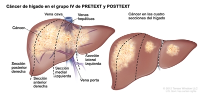 Cáncer de hígado en el grupo IV de PRETEXT y POSTTEXT. En la imagen se observan 2 hígados. Las líneas punteadas dividen cada hígado en 4 secciones verticales de casi el mismo tamaño. En el primer hígado, el cáncer se encuentra en las 4 secciones. En el segundo hígado, el cáncer se encuentra en las 2 secciones de la izquierda y además se observan manchas de cáncer en las 2 secciones de la derecha.
