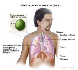 Cáncer de pulmón en estadio IIB (Parte 1). En la imagen se muestran un tumor primario que mide 5 cm o menos en el pulmón derecho, y ganglios linfáticos cancerosos en el mismo pulmón que el tumor primario. También se observan la tráquea, el bronquio principal, la pleura y el diafragma.