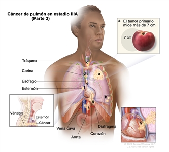 Cáncer de pulmón en estadio IIIA (Parte 3). En la imagen se observa lo siguiente: a) un tumor primario que mide más de 7 cm en el pulmón izquierdo; b) tumores separados en un lóbulo del pulmón diferente al del tumor primario. También se observa cáncer que se diseminó a los siguientes sitios: c) la tráquea, d) la carina, e) el esófago, f) el esternón, g) el diafragma, h) el corazón, i) la aorta y la vena cava.