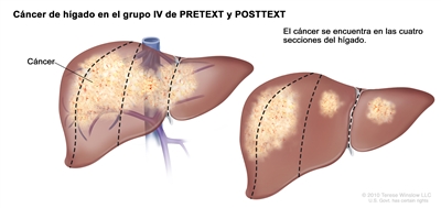 Cáncer de hígado en el grupo IV de PRETEXT y POSTTEXT. En la imagen se observan 2 hígados. Las líneas punteadas dividen cada hígado en 4 secciones verticales de casi el mismo tamaño. En el primer hígado, el cáncer se encuentra en las 4 secciones. En el segundo hígado, el cáncer se encuentra en las 2 secciones de la izquierda y también se observan manchas de cáncer en las 2 secciones de la derecha.