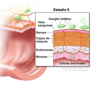 Carcinoma colorrectal in situ en estadio 0. En la imagen se observa un corte transversal del colon o el recto. En el recuadro se muestran las capas de la pared del colon o el recto y células anormales en la mucosa. También se muestran la submucosa, las capas de músculo, la serosa, un vaso sanguíneo y ganglios linfáticos.