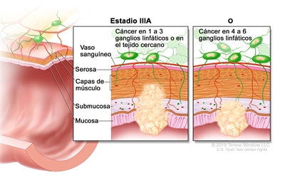 Cáncer colorrectal en estadio IIIA. En la imagen se muestra un corte transversal del recto o el colon y un recuadro de dos paneles. En cada panel se muestran las capas de la pared del colon o el recto: la mucosa, la submucosa, las capas de músculo y la serosa. También se observan vasos sanguíneos y ganglios linfáticos. En el primer panel se observa cáncer en la mucosa, la submucosa, las capas de músculo y en dos ganglios linfáticos. En el segundo panel se observa cáncer en la mucosa, la submucosa y en cinco ganglios linfáticos.