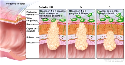 Cáncer colorrectal en estadio IIIB. En la imagen se muestra un corte transversal del colon o el recto y un recuadro de tres paneles. En cada panel se muestran las capas de la pared del colon o el recto: la mucosa, la submucosa, las capas de músculo y la serosa. También se muestran vasos sanguíneos y ganglios linfáticos. En el primer panel se observa cáncer en todas las capas, en tres ganglios linfáticos y en el peritoneo visceral. En el segundo panel se observa cáncer en todas las capas y en cinco ganglios linfáticos cercanos. En el tercer panel se observa cáncer en la mucosa, la submucosa, las capas de músculo y en siete ganglios linfáticos.