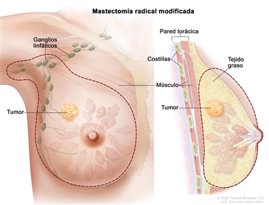 Mastectomía radical modificada. En la imagen de la izquierda una línea de puntos señala la zona que se extirpa, abarca toda la mama y la mayoría de los ganglios linfáticos de la axila. En la imagen de la derecha se observa un corte transversal de la mama que incluye el tejido graso y la pared torácica (costillas y músculos). También se muestra un tumor en la mama.