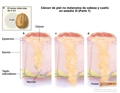 Cáncer de piel no melanoma de cabeza y cuello en estadio III (Parte 1). En la imagen se observan varias situaciones: a) en un recuadro, se muestra un tumor que mide más de 4 cm, que es casi el tamaño de una nuez. Además, se observa que el cáncer se disemina a través de la epidermis por: b) el tejido que reviste los nervios debajo de la dermis, c) debajo del tejido subcutáneo, y d) el hueso.