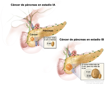 Cáncer de páncreas en estadio l; en la imagen de la izquierda, se observa el cáncer de páncreas en estadio lA. El cáncer está en el páncreas y el tumor mide 2 cm o menos. En el recuadro, se muestra que 2 cm es casi el tamaño de un maní. En el dibujo de la derecha, se observa el cáncer de páncreas en estadio lB. El cáncer está en el páncreas y el tumor mide más de 2 cm, pero no más de 4 cm. En el recuadro, se muestra que 2 cm es casi el tamaño de un maní y que 4 cm es casi el tamaño de una nuez.