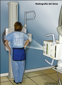 Radiografía del tórax. En el dibujo se muestra a una paciente de pie con la espalda hacia la máquina de rayos-X. Las radiografías se utilizan para tomar imágenes de los órganos y huesos del tórax. Los rayos X pasan a través del paciente y se plasman en una película.
