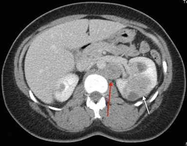 Vista de un corte transversal del cuerpo en donde se observan tumores en ambos riñones. Hay un tumor más pequeño en el riñón izquierdo y un tumor más grande en el riñón derecho. Junto al tumor más grande, se observa un ganglio peritoneal.