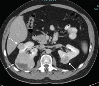 Vista de un corte transversal del cuerpo en donde se observan dos tumores en el riñón izquierdo y un tumor en el riñón derecho.