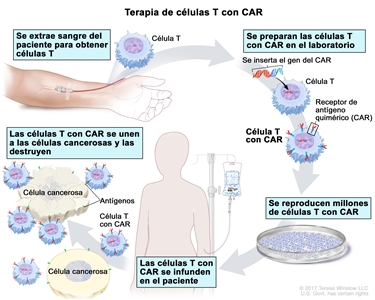 Terapia de células T con CAR; en el dibujo se muestra que se extrae sangre de una vena del brazo de un paciente para obtener células T. También se muestra que se prepara en el laboratorio un receptor especial, que se llama receptor de antígeno quimérico (CAR); se inserta el gen que produce el CAR en las células T y luego se reproducen millones de células T con CAR. Además, se muestra que el paciente recibe las células T con CAR por infusión, y que luego estas células se unen a los antígenos de las células cancerosas y las destruyen.