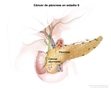 Cáncer de páncreas en estadio 0. En la imagen, se observan células anormales en el páncreas.