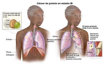 Cáncer de pulmón en estadio IB. Se observan dos imágenes. En la imagen de la izquierda, se observa un tumor en el pulmón derecho que mide más de 3 cm, pero no más de 4 cm. También se muestran la pleura y el diafragma. En la imagen de la derecha, se observa un tumor primario en el pulmón izquierdo que mide 4 cm o menos; además, se observan las siguientes situaciones: a) cáncer en el bronquio principal izquierdo; b) cáncer en la membrana interna que recubre el pulmón (recuadro inferior); c) todo el pulmón o una parte de este se desinfló o presenta neumonitis (inflamación del pulmón). También se observan la carina y, en el recuadro inferior, una costilla.